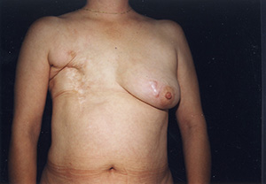 Breast Reconstruction 2a